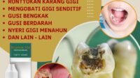 Obat Herbal Gusi Bengkak