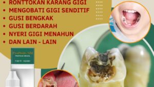 Obat Herbal Gusi Bengkak