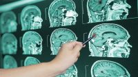 Tiga Pasien Cerita Proses Sembuh dari Tumor Otak