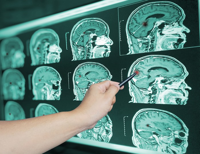 9 Obat Tumor Otak Medis - KlikDokter Tiga Pasien Cerita Proses Sembuh dari Tumor Otak