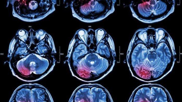 Kenali 11 Jenis Tumor Otak, dari yang Ringan hingga Ganas Sembuh dari Tumor Otak, Pasien Ini Bagikan Pengalaman