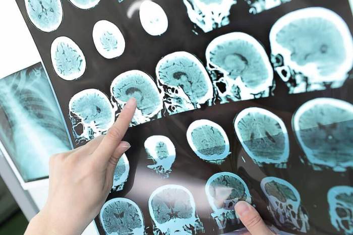 Patients History - Tumor Otak Sembuh dari Tumor Otak, Pasien Ini Bagikan Pengalaman