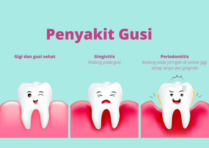 Tanya Jawab : Sakit Gigi Ternyata Bisa Memicu Serangan Jantung - Dental ID Hubungan Antara Gigi dan Kesehatan Jantung