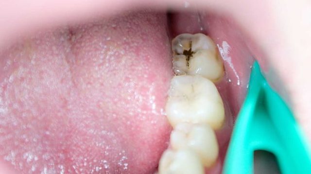 Cegah Gigi Berlubang Tanpa Harus ke Dokter